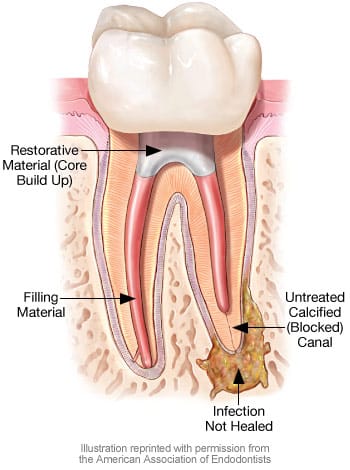 Re-Root Canal Treatment