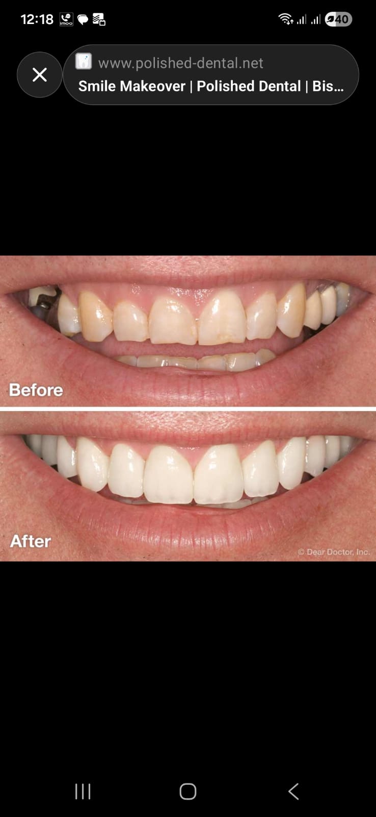 Smile Designing and Veneers
