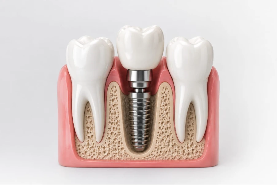 what is dental implant