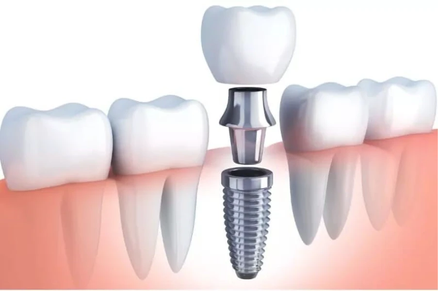 why implanr looks like natural teeth