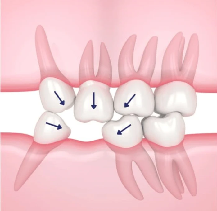 why replace missing teeth