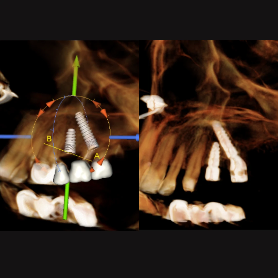 Complex implant graftless restoration with deficient bone 2