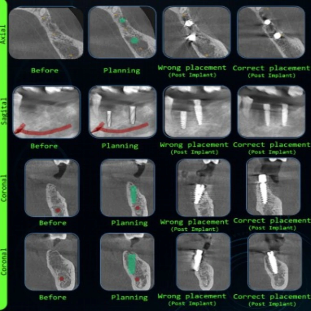 Failed Implant Correction
