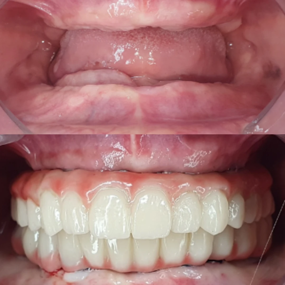 Full mouth implant rehabilitation