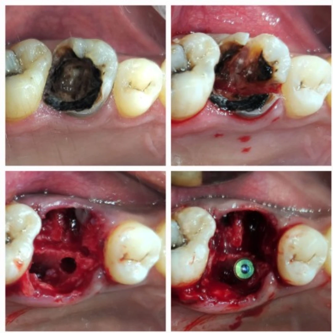 Immediate Implant Placement