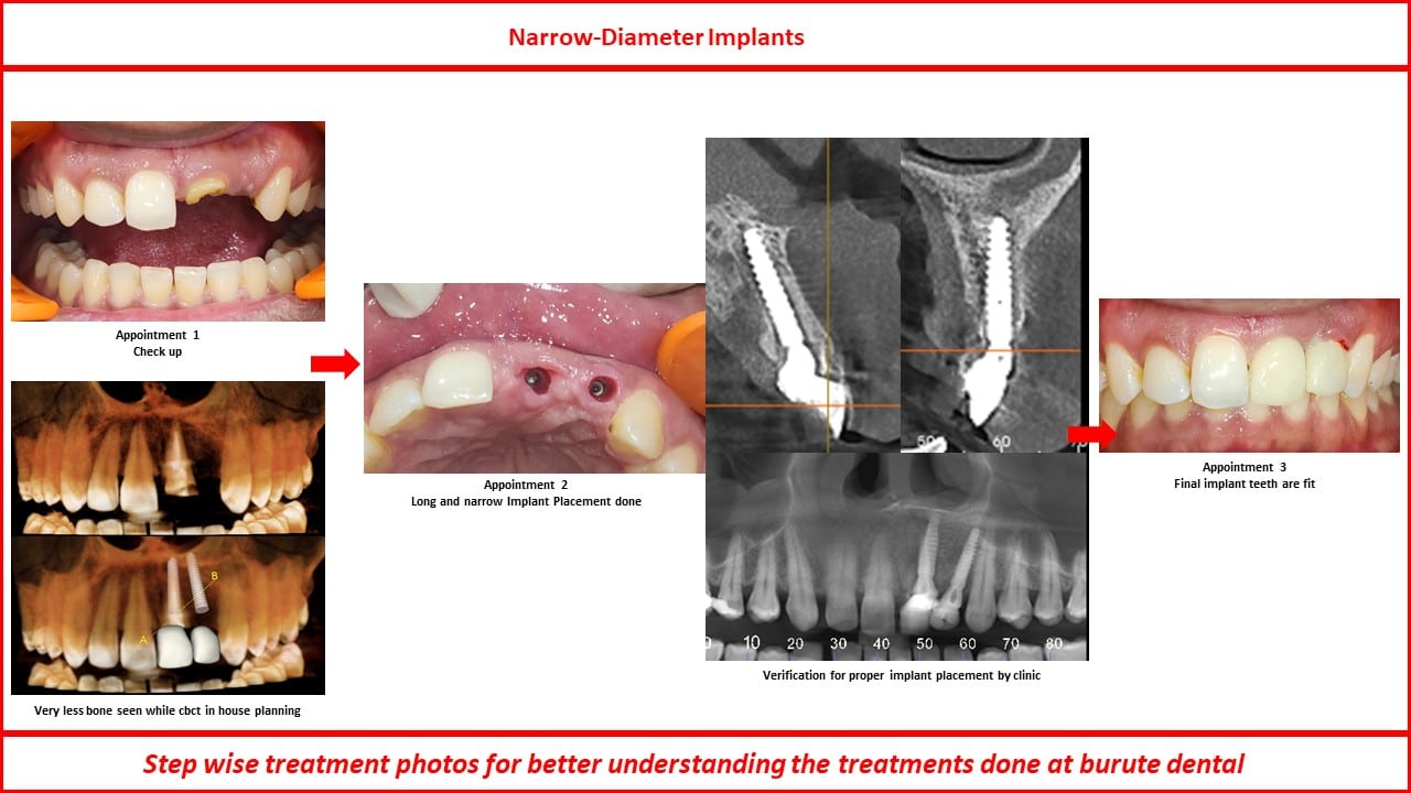Narrow-diameter implants