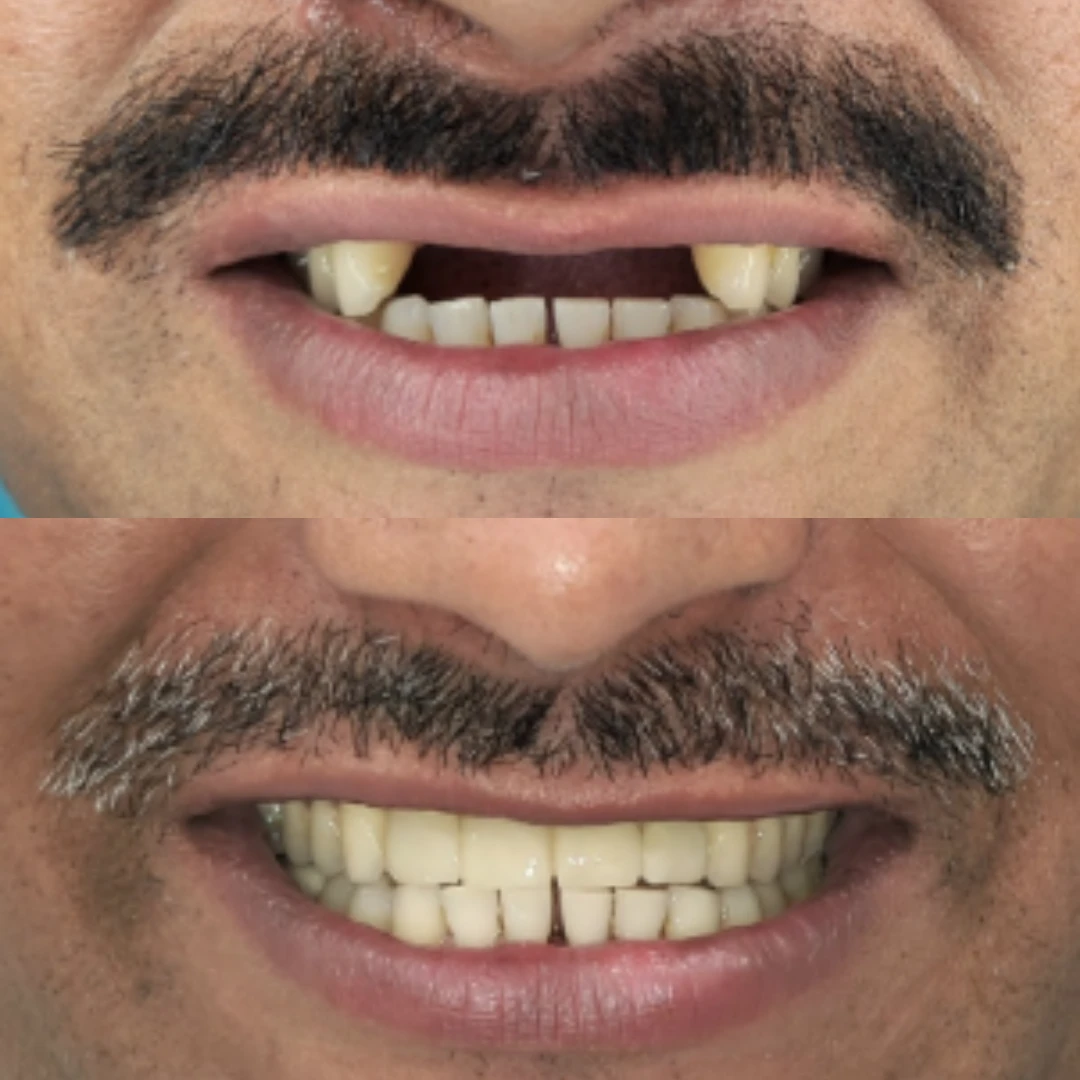 implant asthetic zone